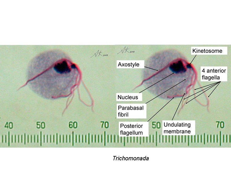 Trichomonada